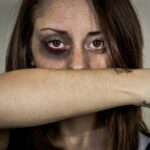 Woman covers her bruised face with her arm