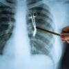Xray showing scissors inside of a patients chest
