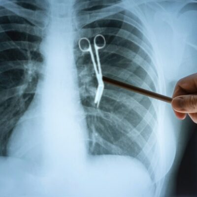 Xray showing scissors inside of a patients chest