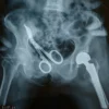 Medical shears showing up in x-ray of patient